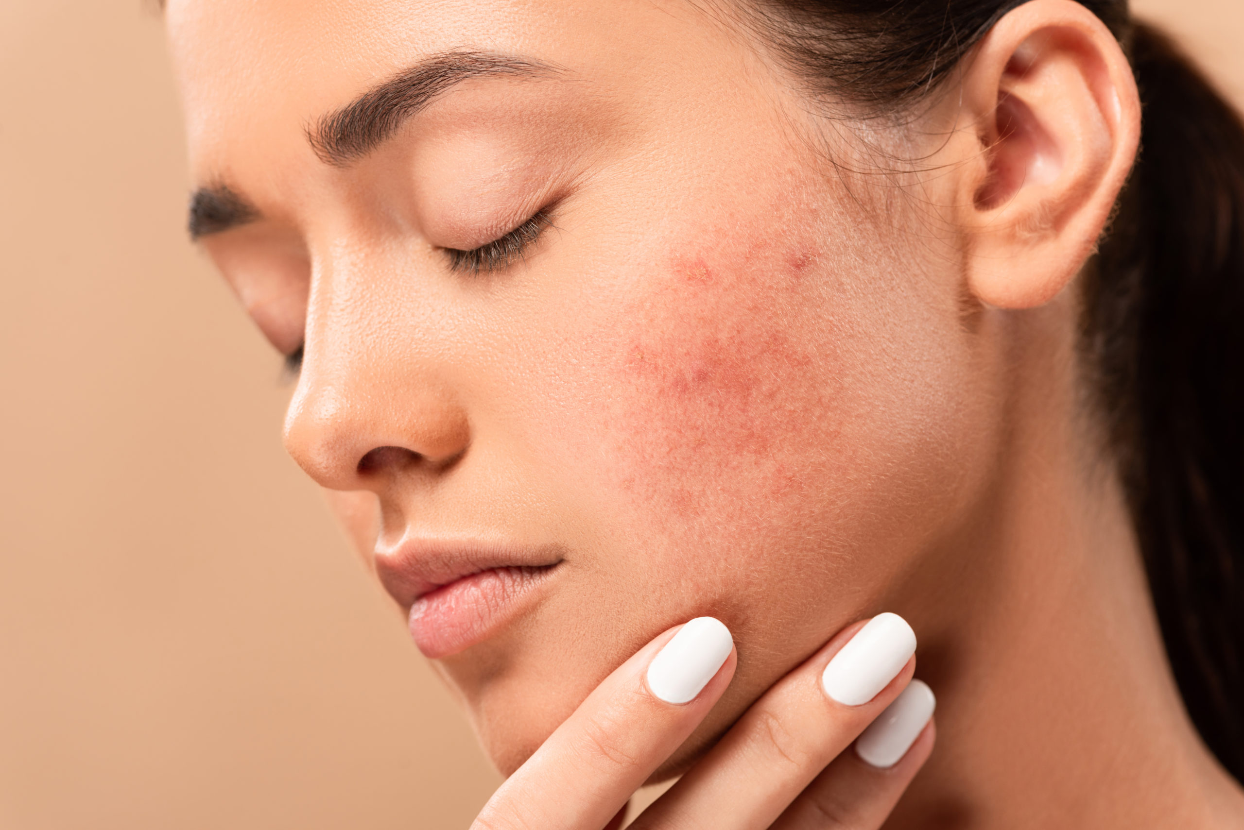 Do Acne Scars Ever Really Go Away?